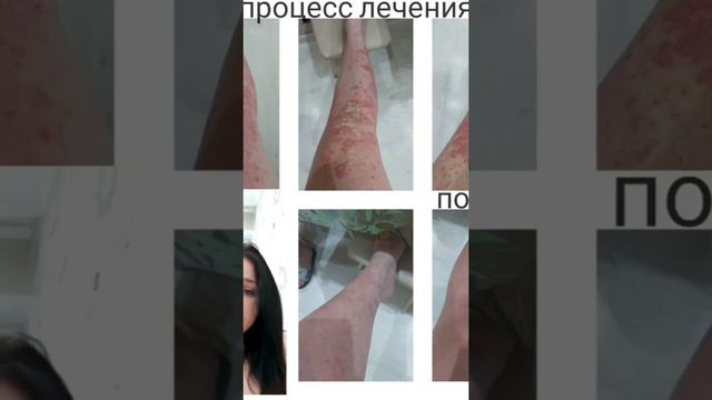Псориаз излечим #алоэ #псориаз #lr