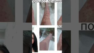 Псориаз излечим #алоэ #псориаз #lr