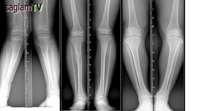 Ayaqlarda eyriliyin duzeldilmesi. Babek Alinagiyev. Travmatoloq-ortoped. Varus deformasiyaları смотреть онлайн