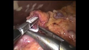 Лапароскопическая гастрэктомия