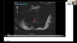 EUS Guided Drainage Of Peripancreatic Fluid Collections - Hakan Senturk