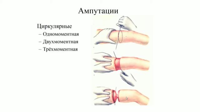 Ампутация канечности.
