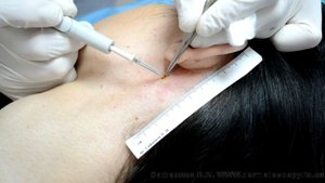 Невус папилломатозный, удаление методом высокочастотной электрохирургии
