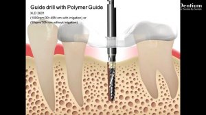 Implantation & sinus lifting in posterior maxilla using Polymer Guide