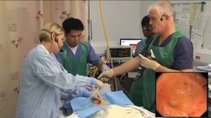 Установка гастростомической трубки  PEG