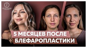 5 МЕСЯЦЕВ ПОСЛЕ БЛЕФАРОПЛАСТИКИ