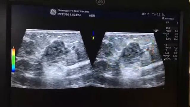 Рак молочной железы . Эластография. Онкология. смотреть онлайн