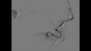 Эмболизация маточных артерий