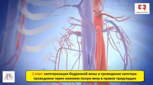 Фибрилляция предсердий_ лечение с помощью эндоваскулярной изоляции ушка левого предсердия окклюдеро
