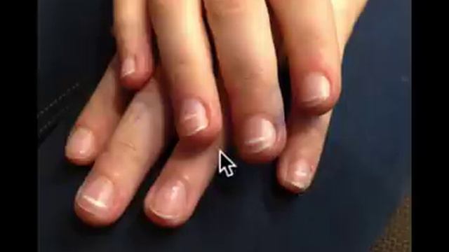 Vitamin-D-Mangel begreifen in 4 Schritten смотреть онлайн