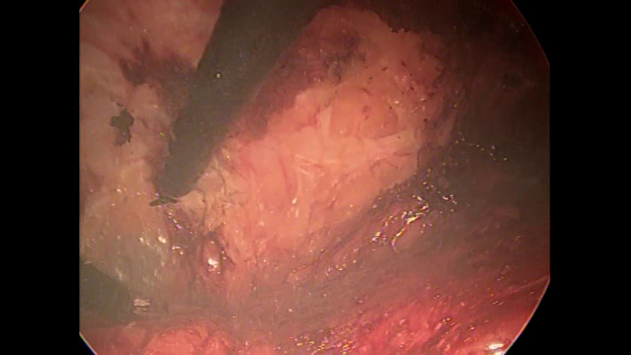 диастаз прямых мышц, diastasis recti, смотреть онлайн