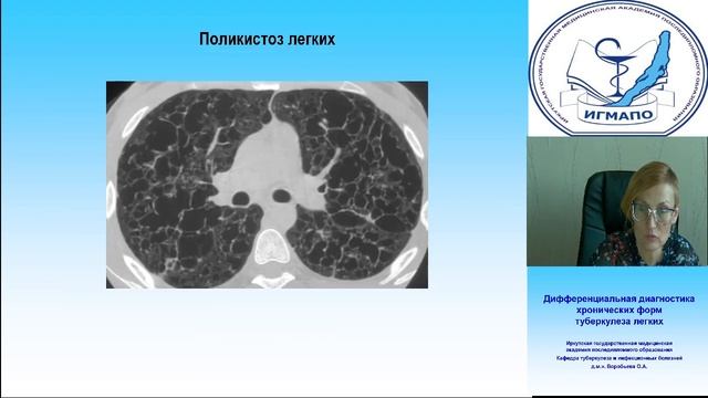 Дифференциальная диагностика хронических форм туберкулеза легких.mp4