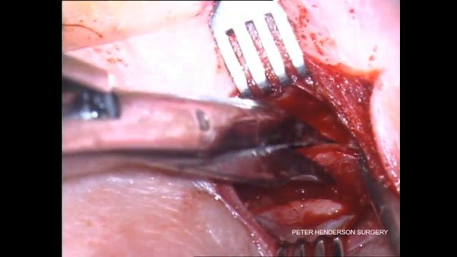 dacryocystorhinostomy смотреть онлайн