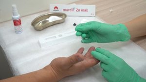 Удаление бородавок и папиллом