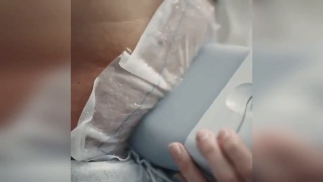 Криолиполиз в CosmoDerm Laser clinic смотреть онлайн