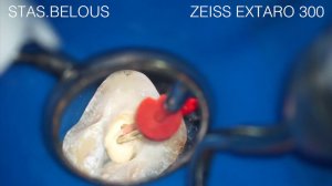 Пломбирование каналов в Зубе с микроскопом ZEISS. Root Canals Zeiss Stas Belous