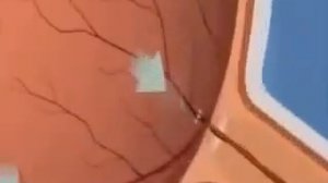 Причины глаукомы