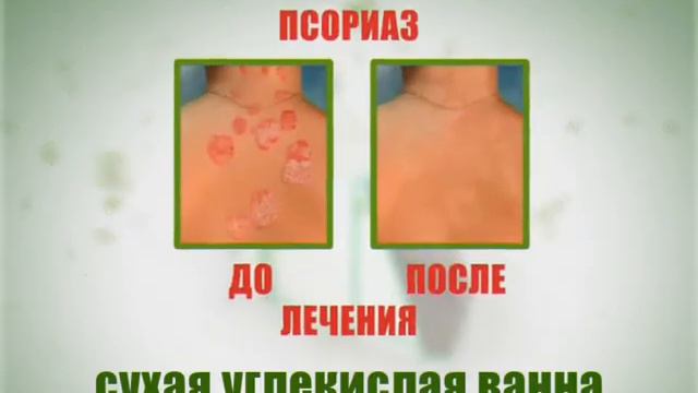 Сухая углекислая ванна в Костной клинике смотреть онлайн