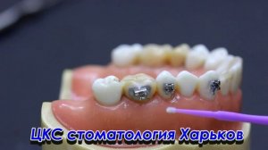 Приклеить брекет в домашних условиях