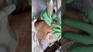 Игольчатый RF лифтинг