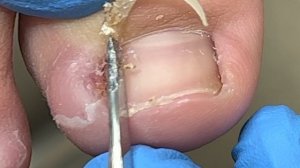 Poor Toenail Condition: Removing Ingrown Nails【Xue Yidao Pedicure】
