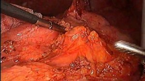 Laparoscopic re-resection of duodenum with D2-lymphadenectomy