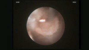 Грыжа диска С5 С6  CESSYS joimax