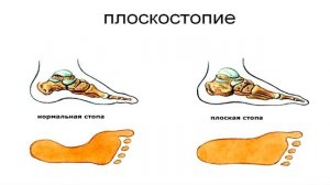 ПОЧЕМУ С ПЛОСКОСТОПИЕМ НЕ БЕРУТ В АРМИЮ ?