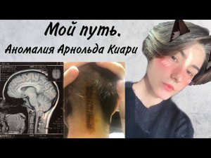 Мой путь. Аномалия Арнольда-Киари.