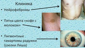 Нейрофиброматоз