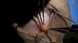 Людоед - муха личинка (Larva man Botfly) Выпуск #1