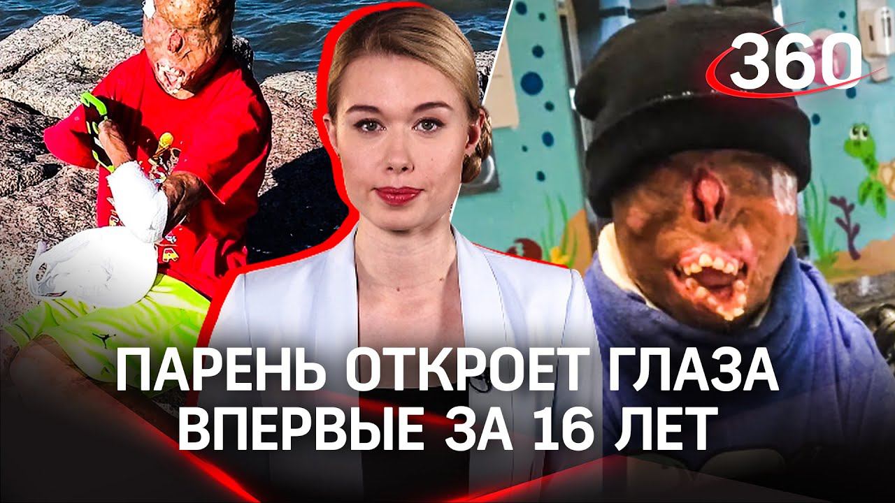Выжил после ожогов 80% тела и мечтает увидеть маму