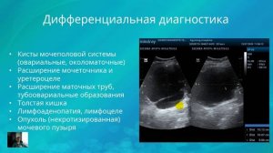 УЗИ дивертикула мочевого пузыря. Дифференциальная диагностика объемных образований малого таза