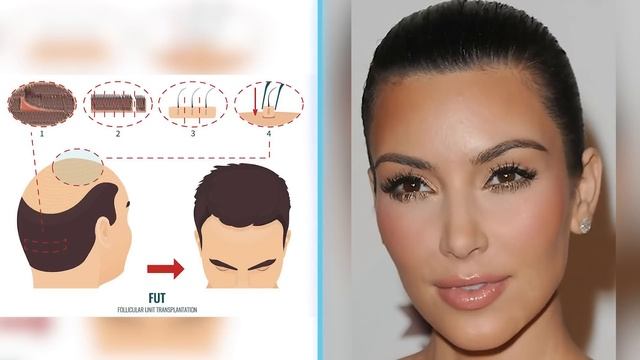 Did Kim Kardashian have a Hair Transplant? | Plastic Surgery Analysis смотреть онлайн