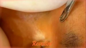 Как профессионально удалять прыщи и черные точки