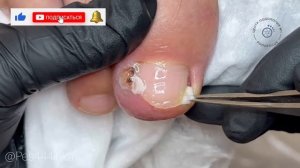 Вросший ноготь и установка скобы 3ТО