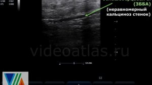 Стенки артерии неровные, кальциноз стенок артерии