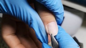 Онихолизис - ноготь отошёл от кожи. Что делать? Пустота под ногтем. Причины, обработка, лечение