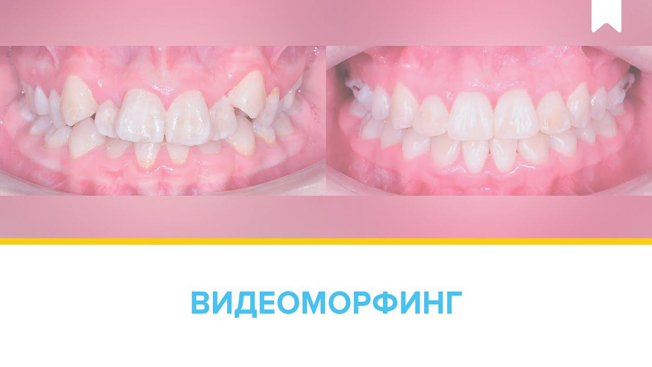 Результаты лечения дистального прикуса и скученности цифровыми брекетами и аппаратом FORSUS
