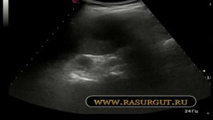 Метастазы селезенки