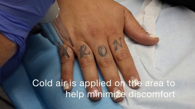 Tattoo Removal - Knuckle Tattoos at Dr. Tattoff Orange County смотреть онлайн