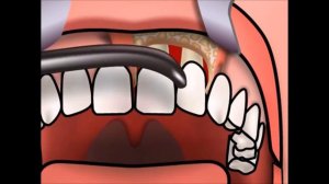 Зубные импланты. Аугментация дефекта кости.