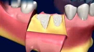 альвеолярный гребень после удаления зубов