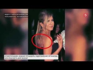 Спустя несколько веков в моду вновь вошло кровопускание