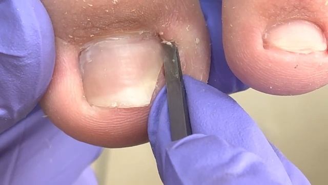 Common paronychia nails, professional pedicure to clean up small inner nails【Doctor Liu Pedicure】 смотреть онлайн