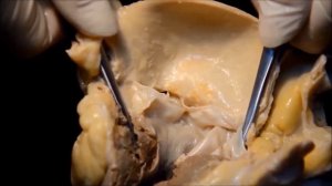 Строение сердца. Левый желудочек.