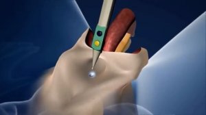 Gender Reassignment Surgery | Conversion from male to female