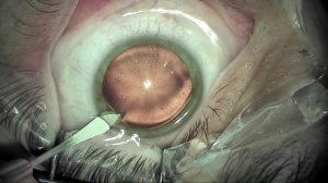 Имплантация факичной торической ИОЛ IPCL 2.0