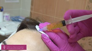 Плазмолифтинг при выпадении волос