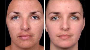 Гликолевый пилинг